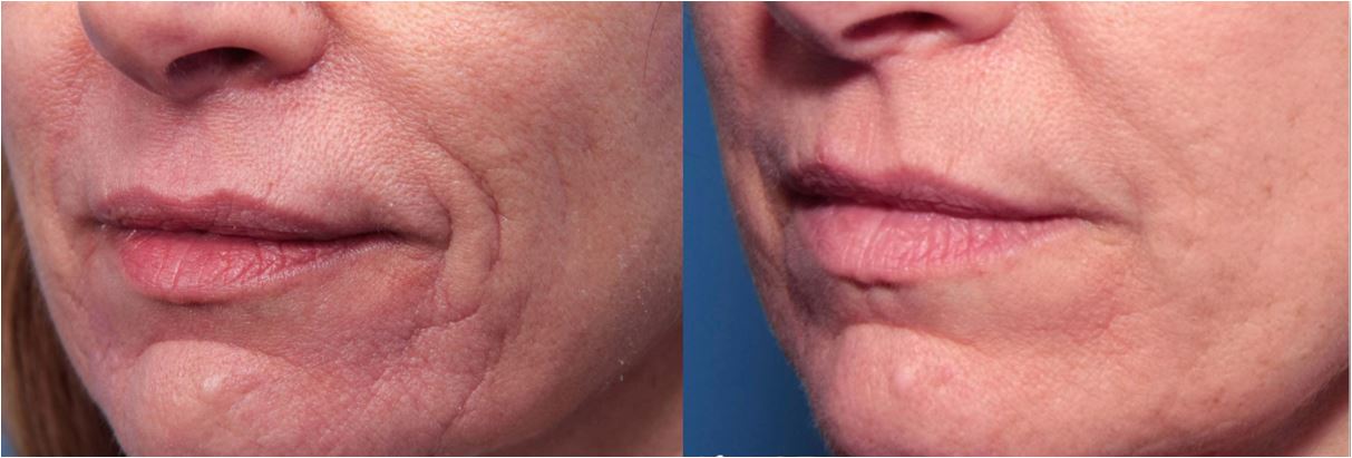 LIFTING non invasif: 4 traitements de Radiofréquence fractionnée – Image 3