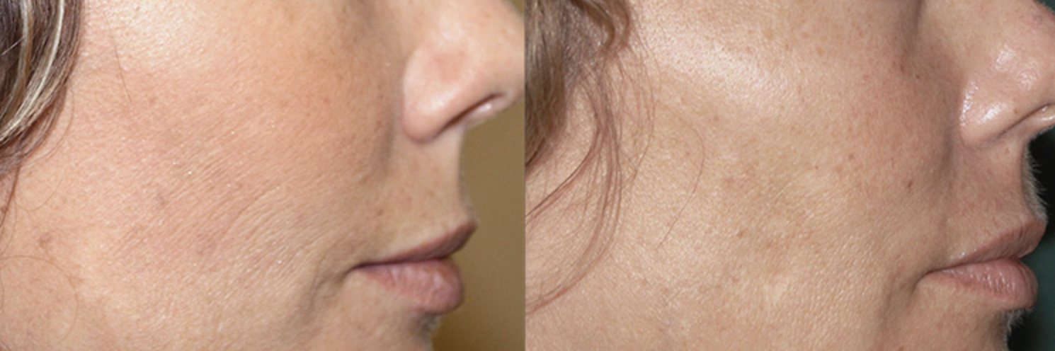 LIFTING non invasif: 4 traitements de Radiofréquence fractionnée – Image 2
